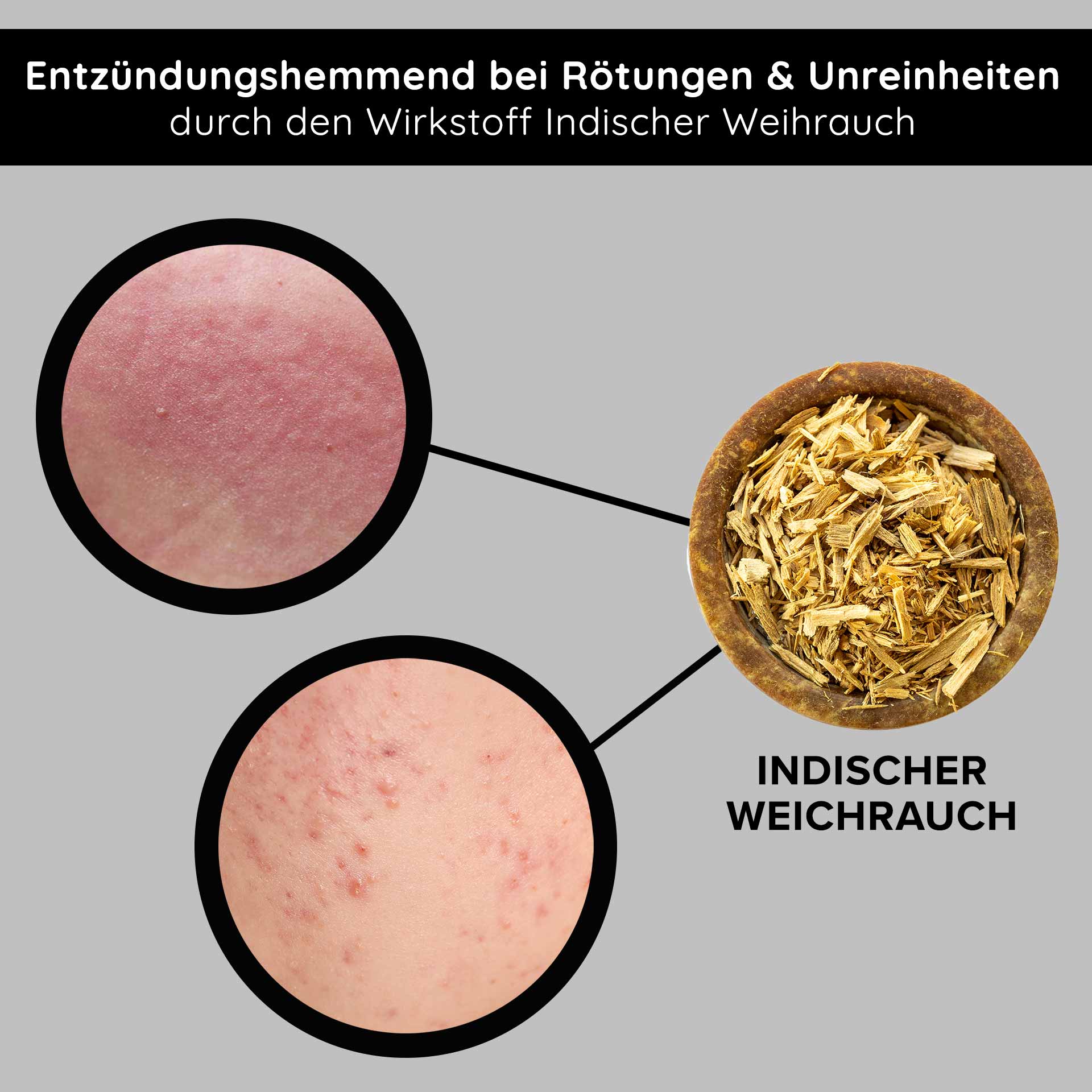 Tri-Peeling 50 ml Enzyme & Fruit Acid Peeling Entzündungshemmendes Indischer Weihrauch zur Reduzierung von Rötungen und Unreinheiten, mit Nahaufnahmen von betroffener Haut.
