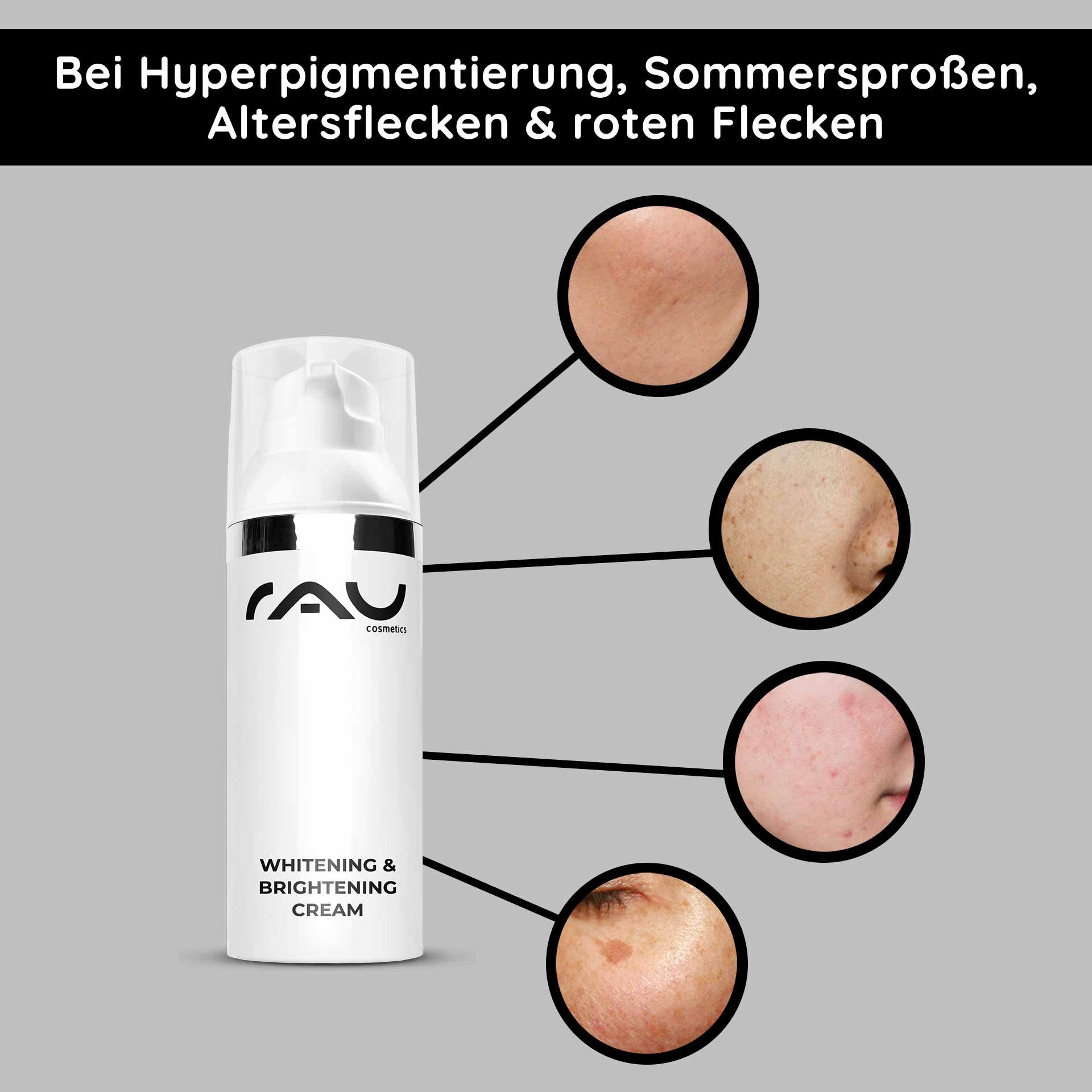 The Whitening & Brightening Cream by RAU Cosmetics highlights skin blemishes like hyperpigmentation, age spots, and red spots, showing effective solutions for skin brightening.