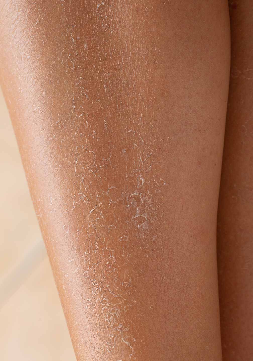 Nahaufnahme einer Beinoberfläche mit trockener, schuppiger Haut, die die Textur zeigt, ideal für RAU Cosmetics Körperlotion.