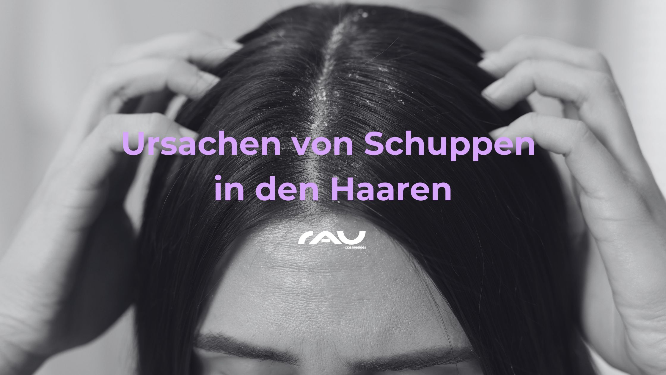 Ursachen von Schuppen in den Haaren Ursachen von Schuppen in den Haaren, Person mit Händen im Haar, sichtbar trockene Schuppen, RAU Cosmetics Logo.