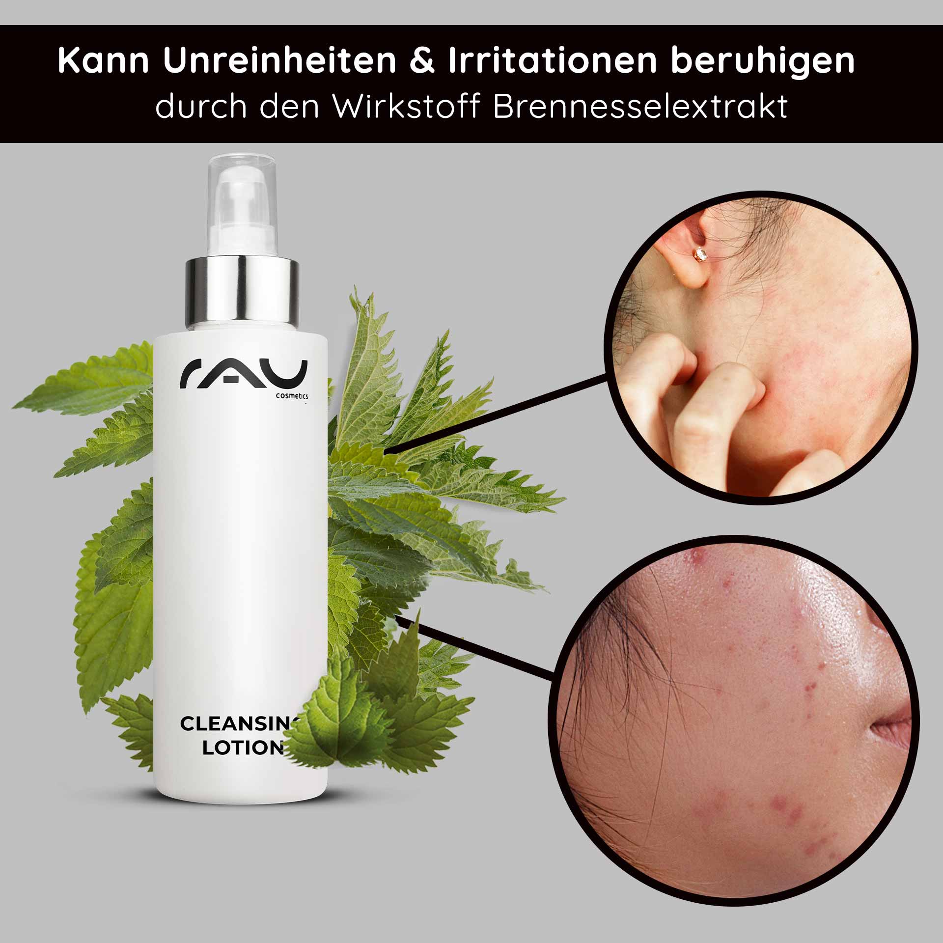 Cleansing Lotion 200 ml - thorough cleansing lotion Flasche der RAU-Reinigungslotion mit Brennnesselblättern im Hintergrund, die die Vorteile bei der Linderung von Unreinheiten und Reizungen hervorhebt und Nahaufnahmen von Haut mit Unreinheiten zeigt.